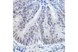 Immunohistochemistry of paraffin-embedded human colon carcinoma using DGCR8 Rabbit pAb (ABIN7266761) at dilution of 1:200 (40x lens). (DGCR8 抗体)