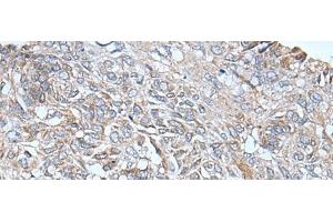 Immunohistochemistry of paraffin-embedded Human lung cancer tissue using ETFB Polyclonal Antibody at dilution of 1:40(x200) (ETFB 抗体)