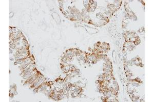 IHC-P Image Immunohistochemical analysis of paraffin-embedded OVCA xenograft, using GPR164, antibody at 1:100 dilution. (OR51E1 抗体)
