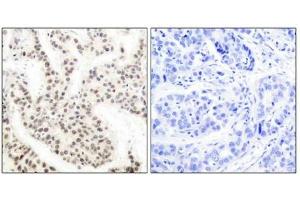 Immunohistochemical analysis of paraffin-embedded human breast carcinoma tissue using Elk-1 (phospho-Thr417) antibody. (ELK1 抗体  (pThr417))