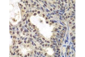 Immunohistochemistry of paraffin-embedded Human oophoroma using CENPC Polyclonal Antibody at dilution of 1:200 (40x lens). (Centromere Protein C Pseudogene 1 (CENPCP1) 抗体)