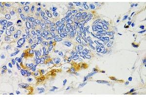 Immunohistochemistry of paraffin-embedded Human gastric cancer using PTPN11 Polyclonal Antibody at dilution of 1:100 (40x lens). (PTPN11 抗体)