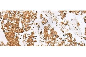 Immunohistochemistry of paraffin-embedded Human lung cancer tissue using SCRN2 Polyclonal Antibody at dilution of 1:60(x200) (SCRN2 抗体)