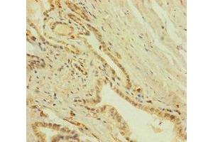 Immunohistochemistry of paraffin-embedded human prostate cancer using ABIN7151756 at dilution of 1:100 (ZNF71 抗体  (AA 101-300))