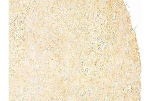 ABIN6261669 and ABIN6273242 at 1/100 staining human glioblastoma by IHC-P. (FAM65B 抗体  (Internal Region))