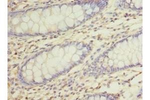 Immunohistochemistry of paraffin-embedded human colon cancer using ABIN7168469 at dilution of 1:100 (RUSC1 抗体  (AA 231-433))