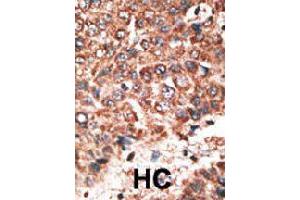 Formalin-fixed and paraffin-embedded human hepatocellular carcinoma tissue reacted with MMP20 polyclonal antibody  , which was peroxidase-conjugated to the secondary antibody, followed by DAB staining. (MMP20 抗体  (Internal Region))