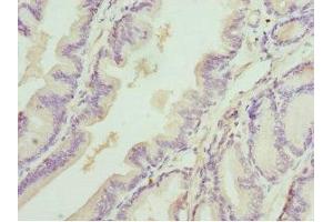 Immunohistochemistry of paraffin-embedded human prostate cancer using ABIN7149547 at dilution of 1:100 (DEDD 抗体  (AA 1-318))