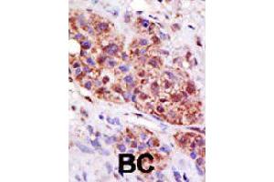 Formalin-fixed and paraffin-embedded human cancer tissue reacted with UBE2B polyclonal antibody  , which was peroxidase-conjugated to the secondary antibody, followed by DAB staining. (UBE2B 抗体  (C-Term))