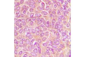 Immunohistochemical analysis of CLASP1 staining in human breast cancer formalin fixed paraffin embedded tissue section.