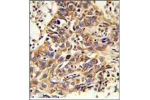 Immunohistochemistry: AP17923PU-N CAT Antibody staining of Formalin-Fixed, Paraffin-Embedded Human Lung carcinoma. (Catalase 抗体  (AA 159-188))