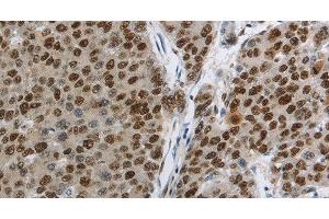 Immunohistochemistry of paraffin-embedded Human liver cancer using MCM3 Polyclonal Antibody at dilution of 1:30 (MCM3 抗体)