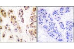 Immunohistochemistry analysis of paraffin-embedded human breast carcinoma, using SSB (Phospho-Ser366) Antibody. (SSB 抗体  (pSer366))