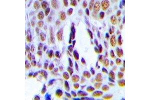 Immunohistochemical analysis of INTS6 staining in human breast cancer formalin fixed paraffin embedded tissue section. (INTS6 抗体)