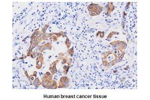 Paraffin embedded sections of human breast cancer tissue were incubated with anti-human FADD (1:50) for 2 hours at room temperature. (FADD 抗体)