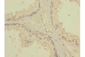 Immunohistochemistry of paraffin-embedded human prostate cancer using ABIN7171903 at dilution of 1:100 (TTC12 抗体  (AA 1-260))
