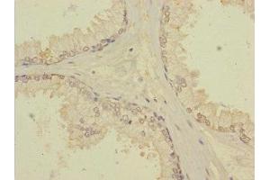 Immunohistochemistry of paraffin-embedded human prostate cancer using ABIN7171903 at dilution of 1:100 (TTC12 抗体  (AA 1-260))