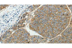 Immunohistochemistry of paraffin-embedded Human liver cancer tissue using SLC16A1 Polyclonal Antibody at dilution 1:50