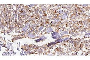 ABIN6277005 at 1/100 staining Human Melanoma tissue by IHC-P. (APCS 抗体  (Internal Region))