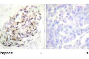 Immunohistochemical analysis of paraffin-embedded human breast carcinoma tissue using KIF20A polyclonal antibody .