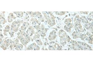 Immunohistochemistry of paraffin-embedded Human gastric cancer tissue using C8orf4 Polyclonal Antibody at dilution of 1:55(x200) (C8orf4 抗体)