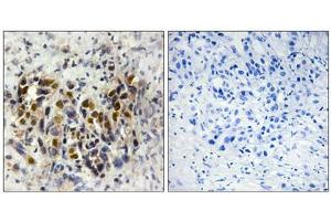 Immunohistochemistry analysis of paraffin-embedded human breast carcinoma tissue, using IRX3 antibody. (IRX3 抗体  (Internal Region))
