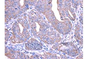 The image on the left is immunohistochemistry of paraffin-embedded Human esophagus cancer tissue using ABIN7128033(THAP6 Antibody) at dilution 1/25, on the right is treated with fusion protein. (THAP6 抗体)