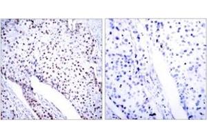 Immunohistochemistry analysis of paraffin-embedded human breast carcinoma tissue, using STAT3 (Ab-705) Antibody. (STAT3 抗体  (AA 672-721))