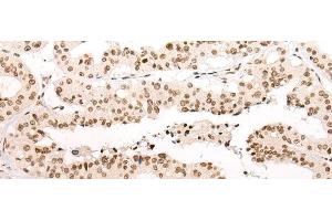 Immunohistochemistry of paraffin-embedded Human liver cancer tissue using VPS51 Polyclonal Antibody at dilution of 1:65(x200) (VPS51 抗体)