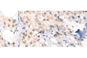Immunohistochemistry of paraffin-embedded Human breast cancer tissue using VPS51 Polyclonal Antibody at dilution of 1:65(x200) (VPS51 抗体)