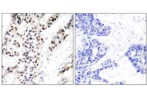 Immunohistochemical analysis of paraffin- embedded human breast carcinoma tissue using Estrogen Receptor-α (phospho-Ser106) antibody (E011071). (Estrogen Receptor alpha 抗体  (pSer106))