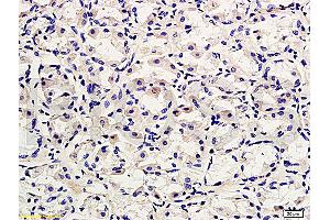 Formalin-fixed and paraffin embedded human gastric adenocarcinoma labeled with Rabbit Anti-CD45/B220 Polyclonal Antibody, Unconjugated (ABIN669606) at 1:200 followed by conjugation to the secondary antibody and DAB staining. (CD45 抗体  (AA 1210-1304))