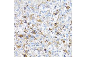 Immunohistochemistry of paraffin-embedded human lung cancer using ACTR2 antibody. (ACTR2 抗体)