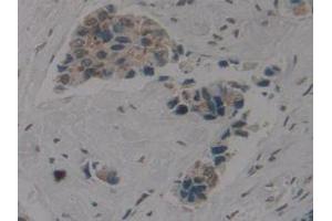 IHC-P analysis of Human Breast Cancer Tissue, with DAB staining. (Cytokeratin 1 抗体  (AA 487-644))