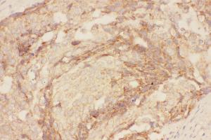 Anti-Eotaxin 3 Picoband antibody,  IHC(P): Human Mammary Cancer Tissue (CCL26 抗体  (AA 24-94))