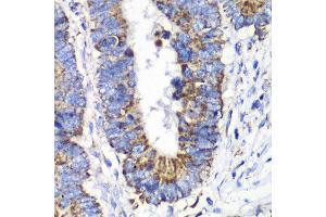 Immunohistochemistry of paraffin-embedded human colon carcinoma using RALB antibody at dilution of 1:100 (x40 lens). (RALB 抗体)