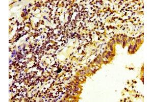 IHC image of ABIN7150781 diluted at 1:200 and staining in paraffin-embedded human lung cancer performed on a Leica BondTM system. (DUSP6 抗体  (AA 100-206))