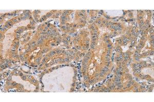 Immunohistochemistry of paraffin-embedded Human thyroid cancer tissue using PTPN4 Polyclonal Antibody at dilution 1:40
