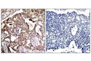 Immunohistochemical analysis of paraffin- embedded human breast carcinoma tissue, using SEK1/MKK4 (Ab-80) antibody (E021132). (MAP2K4 抗体)