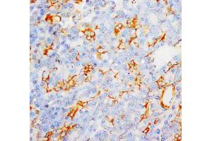 Anti-MPO antibody, IHC(P): Human Liver Cancer Tissue (Myeloperoxidase 抗体  (C-Term))
