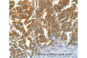 Immunohistochemistry of Human gastric cancer using ASNS Polyclonal Antibody at dilution of 1:60 (Asparagine Synthetase 抗体)