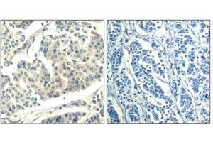 Immunohistochemical analysis of paraffin-embedded human breast carcinoma tissue using ABL1/2(Phospho-Tyr393/439) Antibody(left) or the same antibody preincubated with blocking peptide(right).