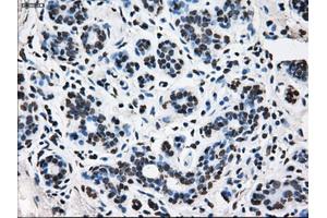 Immunohistochemical staining of paraffin-embedded breast tissue using anti-TTLL12 mouse monoclonal antibody. (TTLL12 抗体)