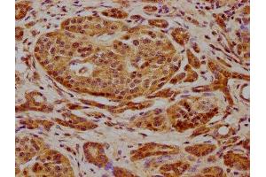 IHC image of ABIN7165606 diluted at 1:600 and staining in paraffin-embedded human pancreatic cancer performed on a Leica BondTM system. (FRY-Like 抗体  (AA 42-739))