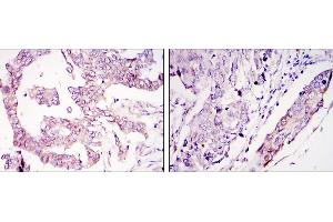 Immunohistochemical analysis of paraffin-embedded ovary tumour tissues (left) and lung cancer (right) using WIF1 mouse mAb with DAB staining. (WIF1 抗体)