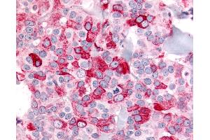 Anti-BAI2 antibody IHC of human Breast, Carcinoma. (BAI2 抗体  (N-Term))