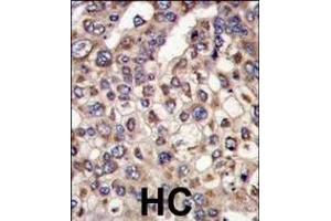Formalin-fixed and paraffin-embedded human hepatocarcinoma tissue reacted with MTMR4 antibody (C-term), which was peroxidase-conjugated to the secondary antibody, followed by DAB staining. (MTMR4 抗体  (C-Term))