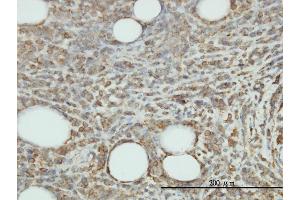 Immunoperoxidase of monoclonal antibody to JAM2 on formalin-fixed paraffin-embedded human malignant lymphoma, diffuse large B tissue. (JAM2 抗体  (AA 29-298))