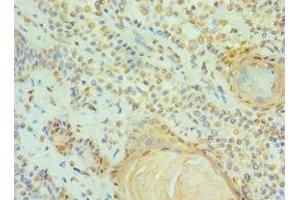 Immunohistochemistry of paraffin-embedded human breast cancer using ABIN7147295 at dilution of 1:100 (CCAR1 抗体  (AA 1-200))