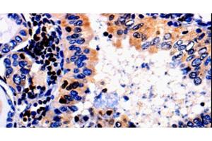 Immunohistochemistry of paraffin-embedded Human thyroid cancer tissue using ALOX5 Polyclonal Antibody at dilution 1:50 (ALOX5 抗体)